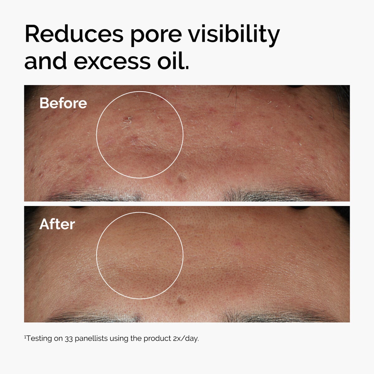 niacinamide-10-zinc-1-j4 ord-niacinamide-zinc-blemish-serum-before-after-pores.jpg