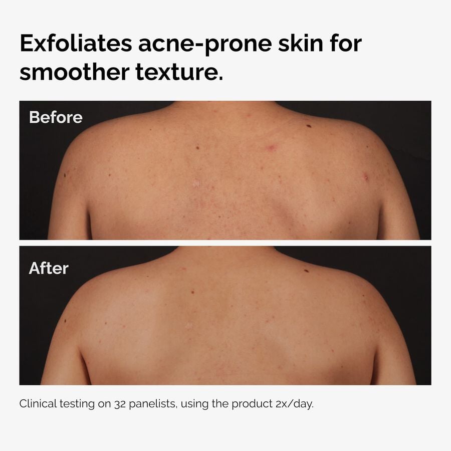 the-body-care-collection-i7 ord-salicylic-acid-body-serum-before-after-graphic-NA.jpg