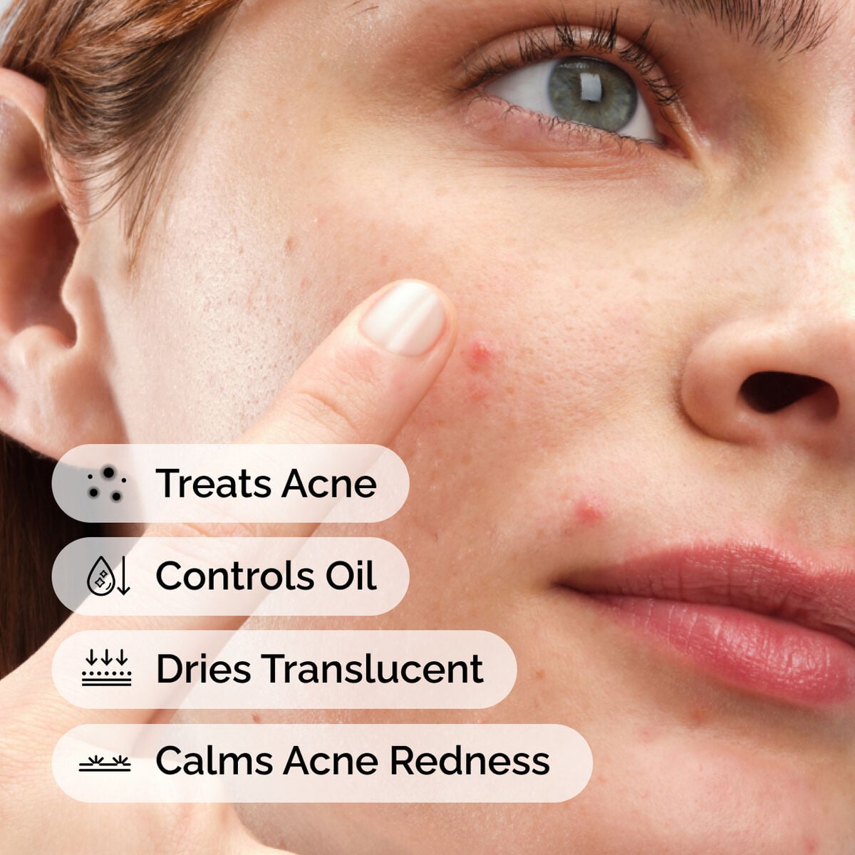 sulfur-10-powder-to-cream-concentrate-p6 ord-sulfur-10pct-powder-to-cream-concentrate-model-application-with-benefits-acne.jpg